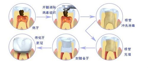 根管治疗示意图