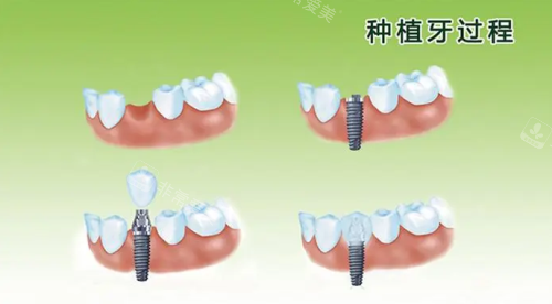 种植牙过程示意图