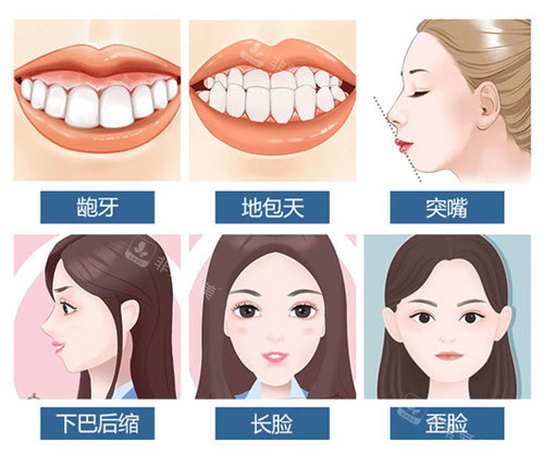 正頜手術(shù)適應(yīng)癥 正頜手術(shù)適應(yīng)癥
