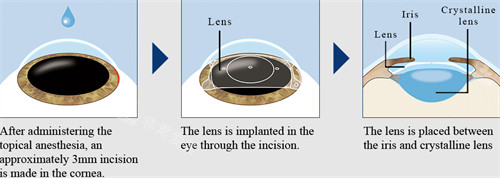 晶体植入手术过程