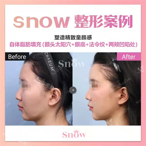 韩国snow整形外科面部填充手术前后对比图