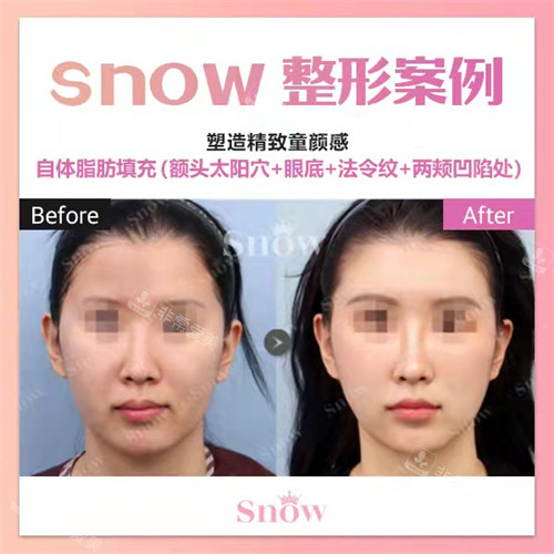 韩国snow整形外科面部填充前后对比