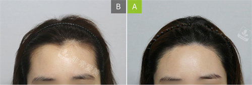  韩国毛阿满医院发际线种植对比图