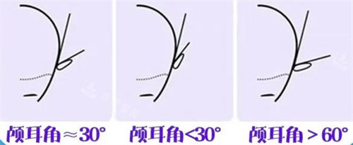 貼面耳精靈耳招風(fēng)耳的區(qū)別 貼面耳精靈耳招風(fēng)耳的區(qū)別
