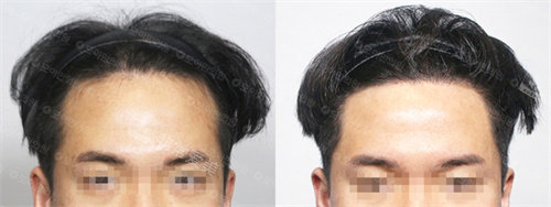 韩国MOAMAN毛阿满医院植发对比图
