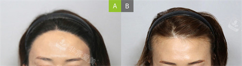 韩国MOAMAN毛阿满医院发际线种植前后对比图