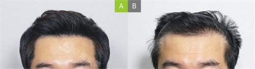 韩国MOAMAN毛阿满医院植发对比图