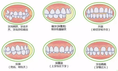 牙齿矫正图示