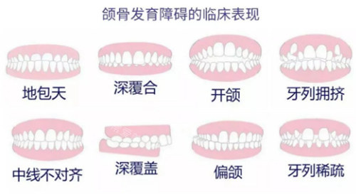 牙齿畸形的不同表现图示