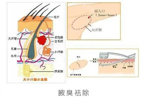 腋臭去除结构图