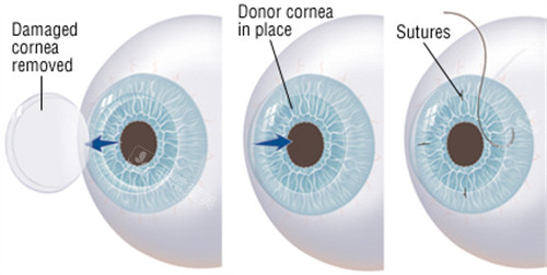 角膜移植手术过程