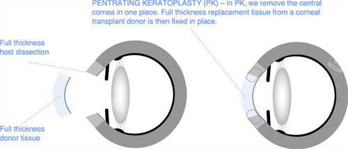 角膜移植手术前后