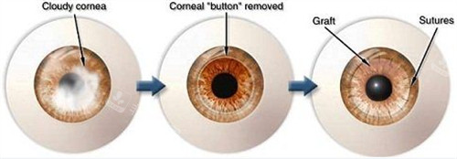 角膜移植手术过程