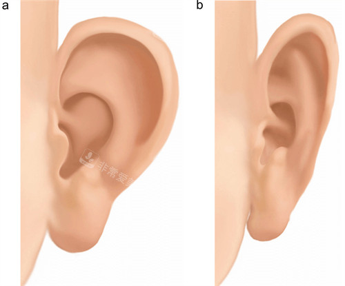 贴发耳手术前后对比图