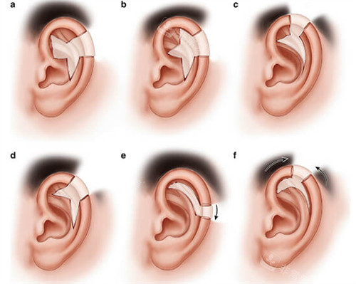 耳畸形手术过程