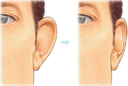 耳朵形状改善