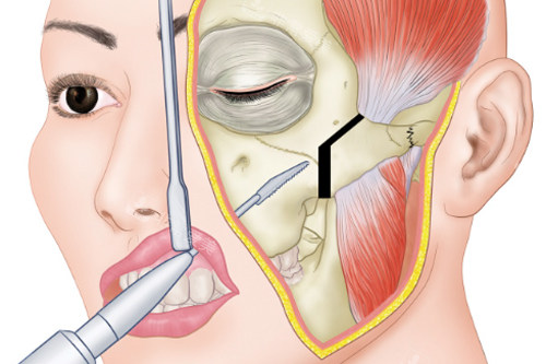 颧骨内推手术过程图解
