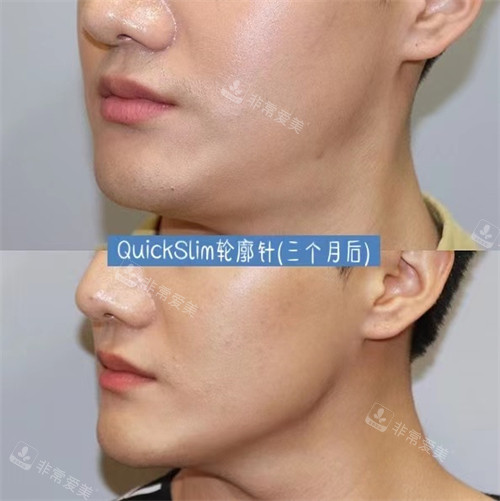 在韓國MinClinic整形注射Quick Slim輪廓針前后對比圖 在韓國MinClinic整形注射Quick Slim輪廓針前后對比圖