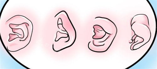 耳朵畸形图片一览，这些耳朵畸形要趁早矫正！