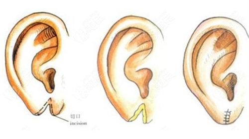耳垂裂手术