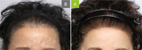 韩国MOAMAN毛阿满医院发际线移植对比图