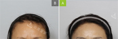 韩国MOAMAN毛阿满医院发际线移植前后图