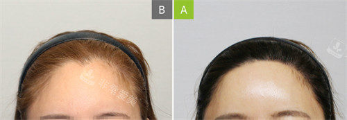 韩国MOAMAN毛阿满医院发际线植发对比