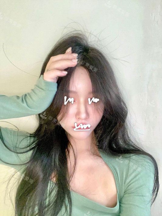 韓國minclinic打水光成效照片
