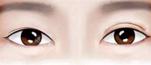 不同宽度的双眼皮展示图