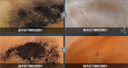 minclinic微整形皮膚科汗腺治療圖 minclinic微整形皮膚科汗腺治療圖