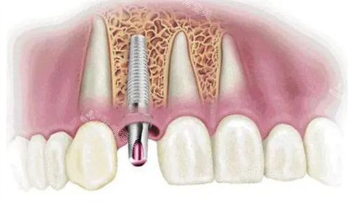 种植牙动画图