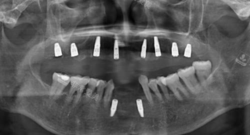 牙齿修复术后ct照片