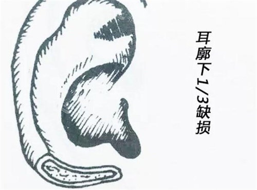 耳垂缺损