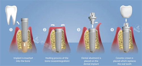 种植牙口腔手术过程