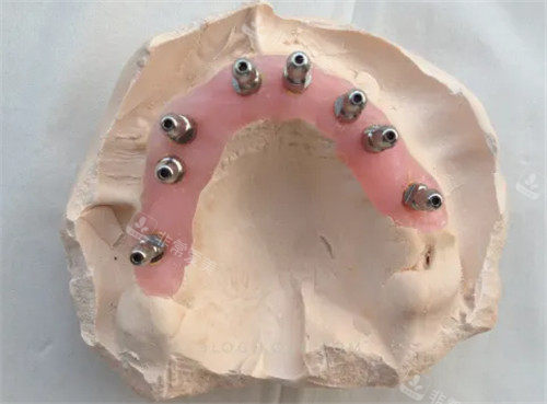 牙齿修复模具