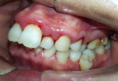 牙周炎细节照片