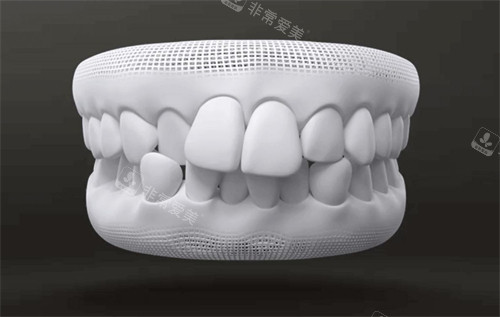牙齿畸形模型图示
