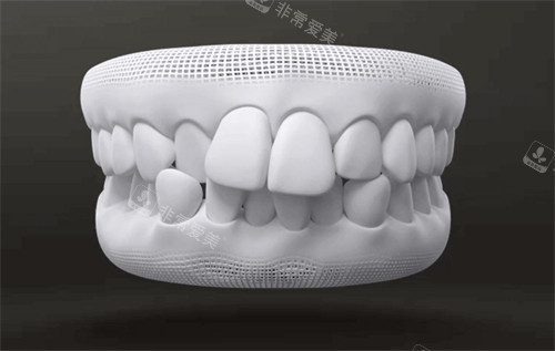 牙齒畸形模型圖示 牙齒畸形模型圖示