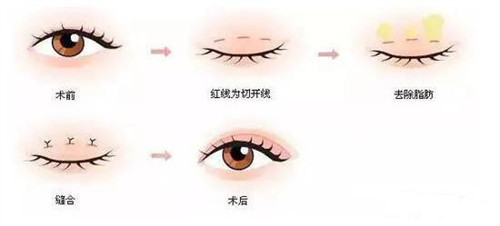 三点定位双眼皮手术过程