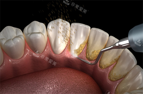 洁牙手术清洁牙齿上的牙结石