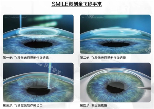 全飞秒手术过程