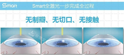 全飞秒手术特点