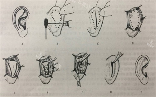 招风耳手术