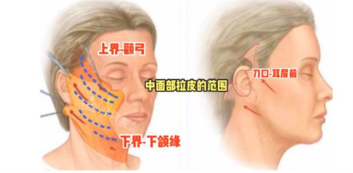 中下面部拉皮部位