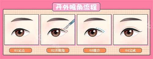外眼角手術(shù)前后對比 外眼角手術(shù)前后對比