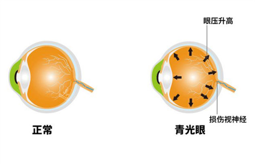 青光眼和正常眼睛的区别对比图