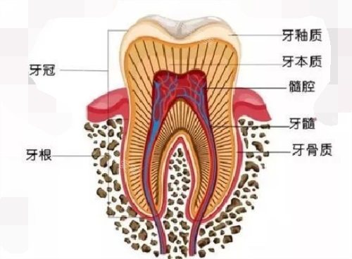 根管治疗示意图