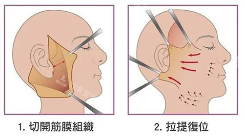 微创小拉皮手术