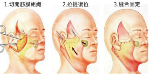 小拉皮手术