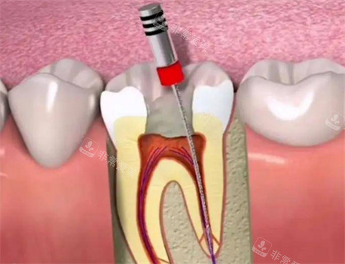 根管治疗的过程图解